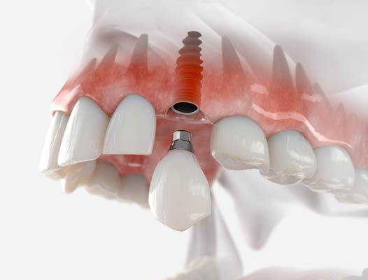 Dental Implant Atlanta, GA